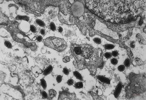 F,41y. | Whipple disease - duodenum F,41y. | Whipple disease - duodenum